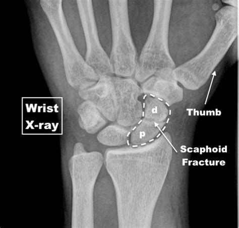 Diagnosis And Management Of Scaphoid Fractures