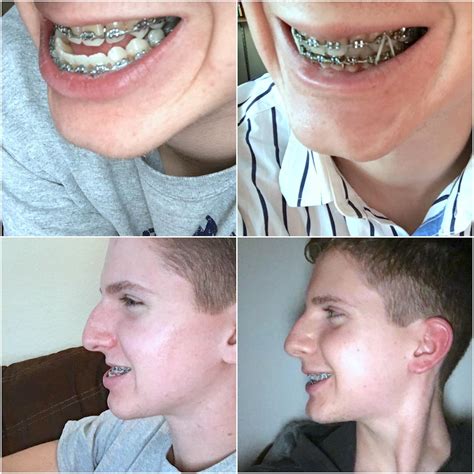 5 Weeks After Double Jaw Surgery Before And After Rbraces