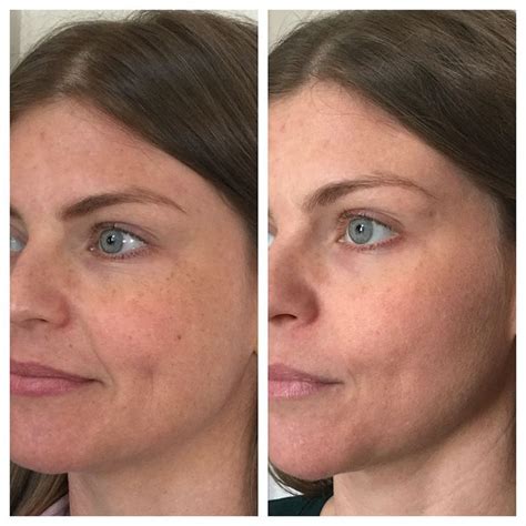 Ipl Before And After Skin Skin Care Ipl