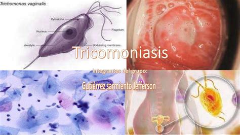 Tricomoniasis Apuntes De Medicina Salud UDocz