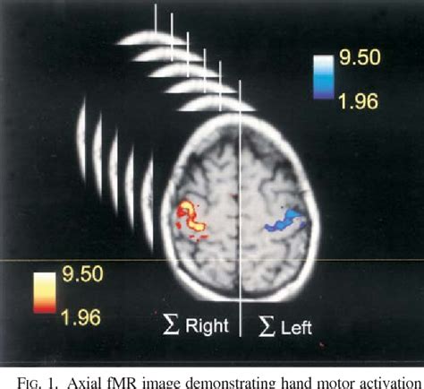 Figure 1 From Patterns Of Functional Magnetic Resonance Imaging