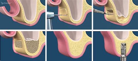 Sinus Lift Methuen Periodontics And Implant Dentistry