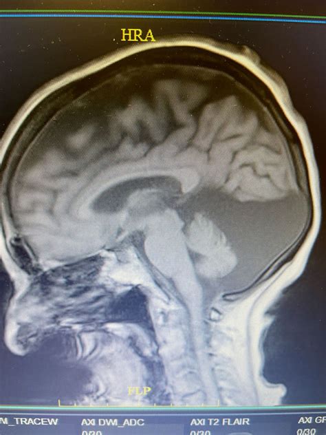 74 Year Old Woman With Occipital Headaches Nspc Brain And Spine Surgery
