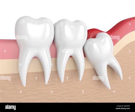 3d Render Of Wisdom Mesial Impaction With Pericoronitis Concept Of