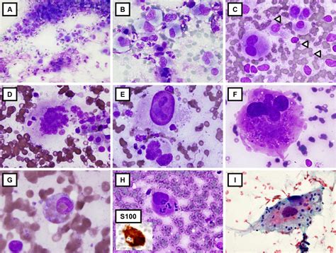 Histiocytic Sarcoma New Insights Into Fna Cytomorphology And Molecular