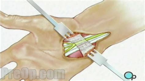 Carpal Tunnel Syndrome Repair Surgery Preop® Patient Education
