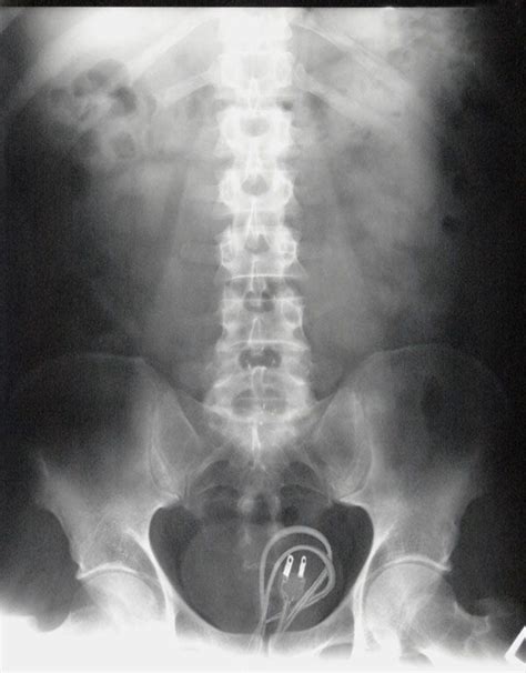 21 Insane Things Found In Butts X Ray Xray Humor Radiology Humor