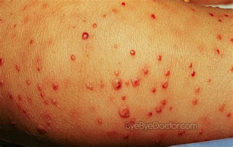 Staph Infection Pictures Symptoms Causes Treatment
