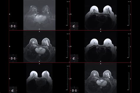 Breast Mri What Is It Procedure And Results