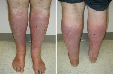 Stasis Dermatitis Causes Symptoms Diagnosis And Treatment