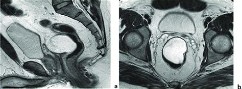 Pelvic Mri Scan Showing A Lobulated Cystic Tumor Located Anteriorly To