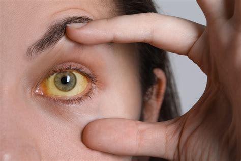 Jaundice Yellow Eyes Skin — Healthintell