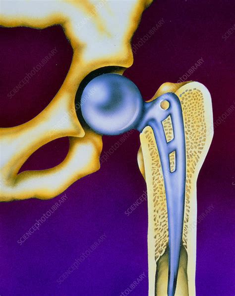 Illustration Of A Prosthetic Hip Joint Stock Image M6000086