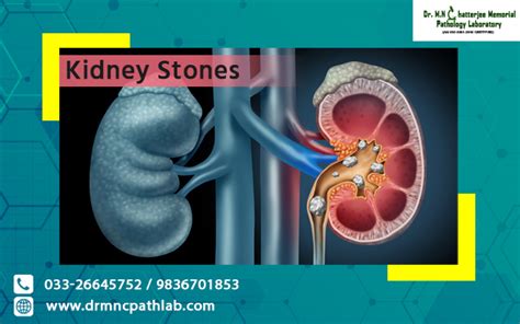 Kidney Stones Dr Mn Chatterjee Pathology