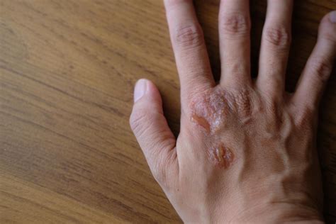 Psoriasis And Hiv What Is The Link