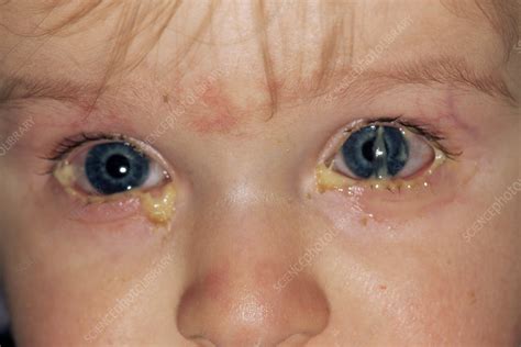 Conjunctivitis Stock Image M1550522 Science Photo Library