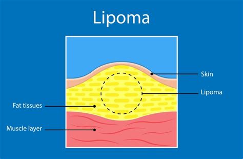 How To Get Rid Of Lipomas Naturally Best Treatment To Follow Doctor