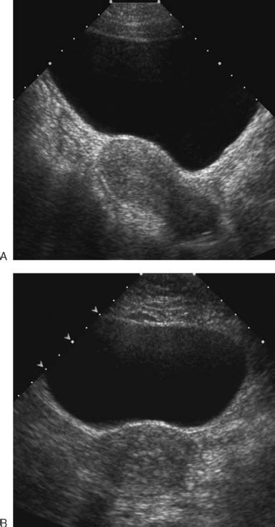 retroverted retroflexed uterus ultrasound