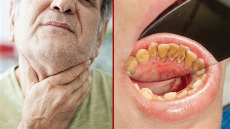 Oral Cancer As Related To Cancers Pictures