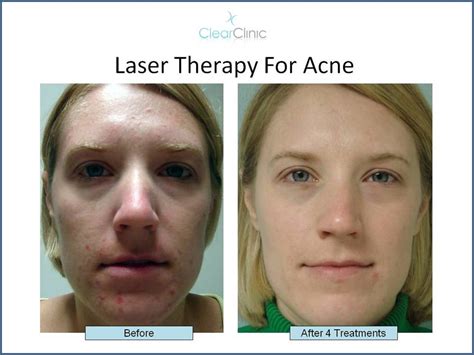 Fastest Acne Treatment In Nyc At Clear Clinic Laser Acne Treatment