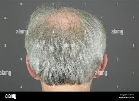 Male Pattern Baldness Stock Photos And Male Pattern Baldness Stock Images