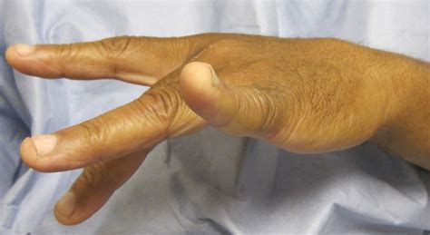 Lipoma Hand Surgery Source