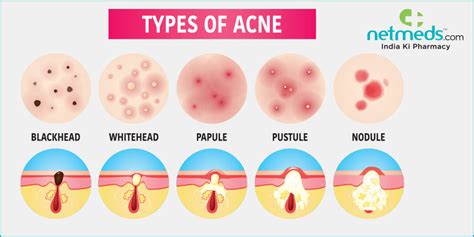 Types Of Acne Know The Difference Between Blackheads Whiteheads Nodules And Cysts