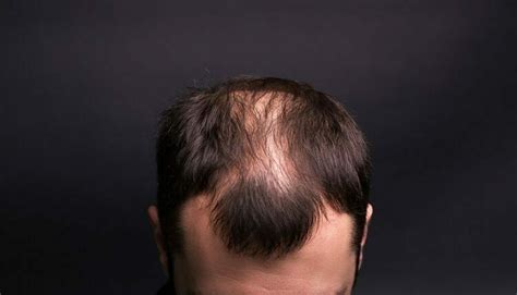 How To Fix Bald Spots And Regrow New Hair In Men
