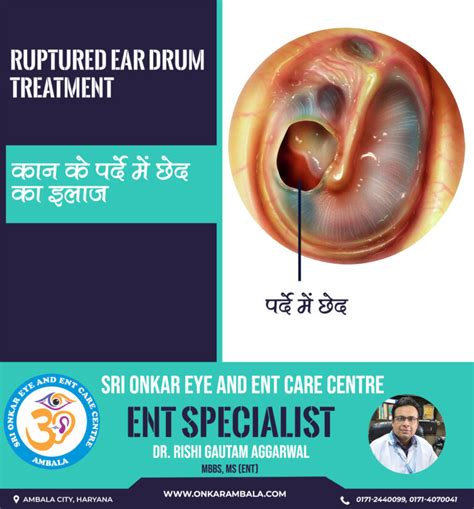Ruptured Eardrum Treatment In Ambala Perforated Eardrum Sri Onkar