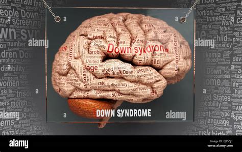Down Syndrome Anatomy Its Causes And Effects Projected On A Human