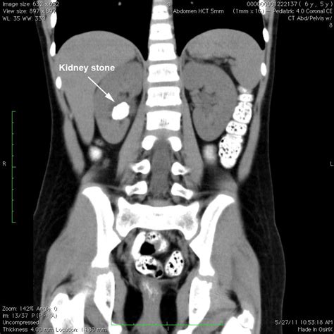 Computed Tomography Ct Or Cat Scan Is A Noninvasive