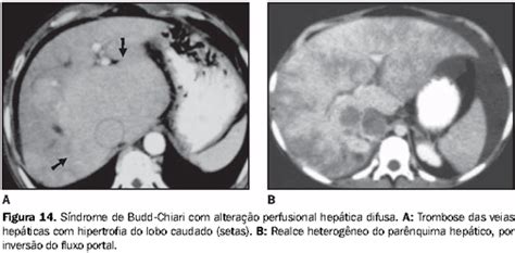 Abstract the restrictive cardiomyopathies are defined as primary myocardial diseases Radiologia Brasileira - Pseudolesões hepáticas na ...