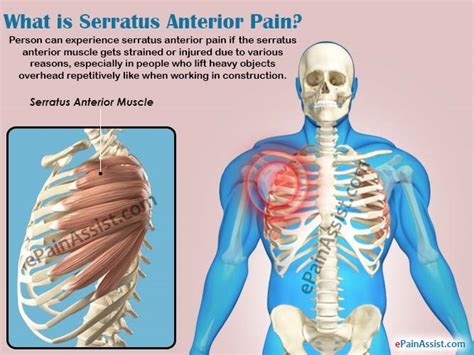 What Is Serratus Anterior Paincausessymptomstreatmentrisk Factors