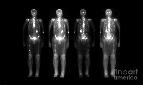 Nuclear Medicine Bone Scan Photograph By Medical Body Scans Fine Art