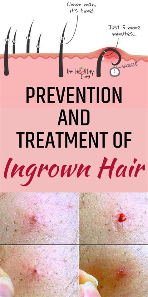 To understand how to remedy an ingrown or prevent it from happening in the first place, you have to know how it's formed. Pin by Ingrown Hair Neck on Medium Length Hair | Ingrown ...