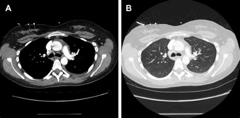 Ct Scan Of The Chest Showing A Small Left Pleural Effusion A With