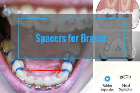 Second opinions (as well as most first opinions you receive from orthodontists) are usually complementary and you will not need to spend any money. SPACERS FOR BRACES - Do They Hurt - Precautions - Removal Time