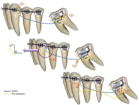 Molar Uprighting A Considerable And Safe Decision To Avoid Prosthetic