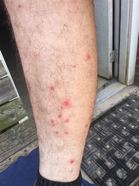 Medical Scabies Reported Along Southern Virginia At The Trek