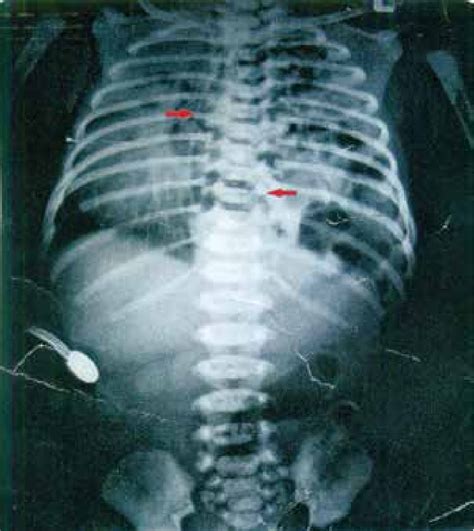 Congenital Diaphragmatic Hernia Left Side With Ng Tube In Side The Left