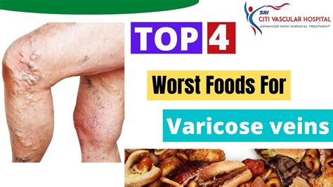 Varicose Veins Diet Top 4 Food You Should Avoid If You Have Varicose