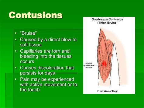 Ppt Chapter 13 Recognizing Different Sports Injuries Powerpoint