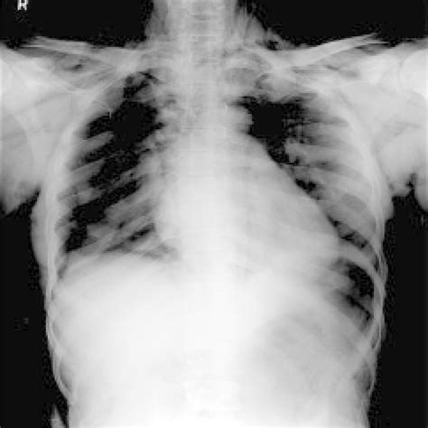 Chest X Ray Showing Bilateral Pneumothorax Download Scientific Diagram