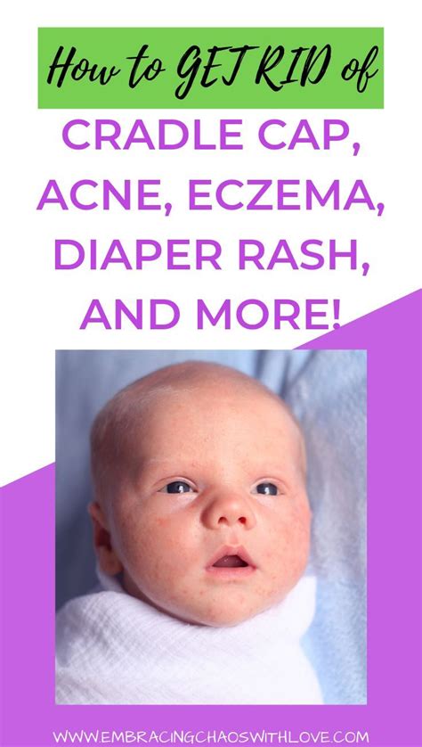 Does Your Baby Have Cradle Cap Or Other Common Newborn Rashes Easily