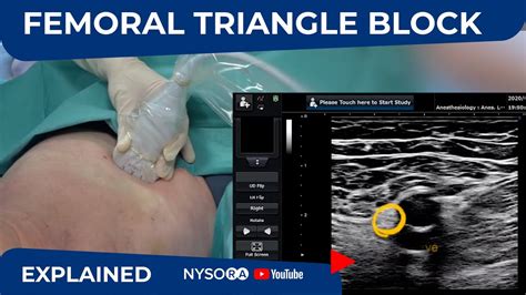 Ultrasound Guided Femoral Triangle Nerve Block Nysoras Regional