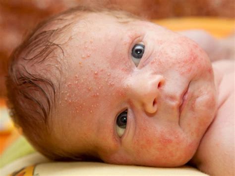 حساسية جلد الاطفال الرضع