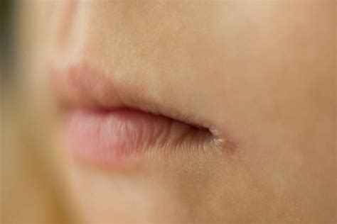 Causes Of Chapped Dry Lips And How To Treat Them Facty Health