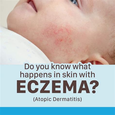 Do You Know What Happens Under The Skin With Atopic Dermatitiseczema