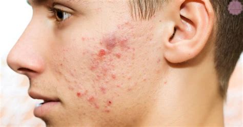 Fungal Acne Vs Closed Comedones Differences And Best Treatment