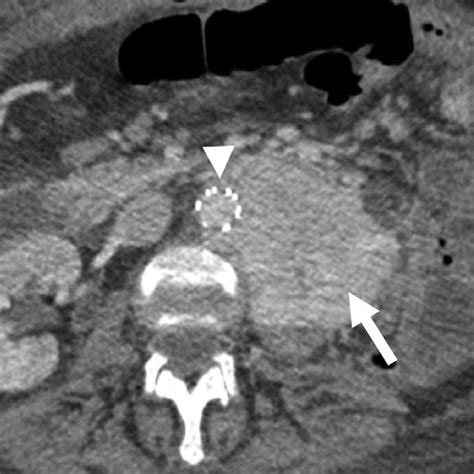 Axial Ct Image Shows A Hypervascular Left Retroperitoneal Mass Arrow